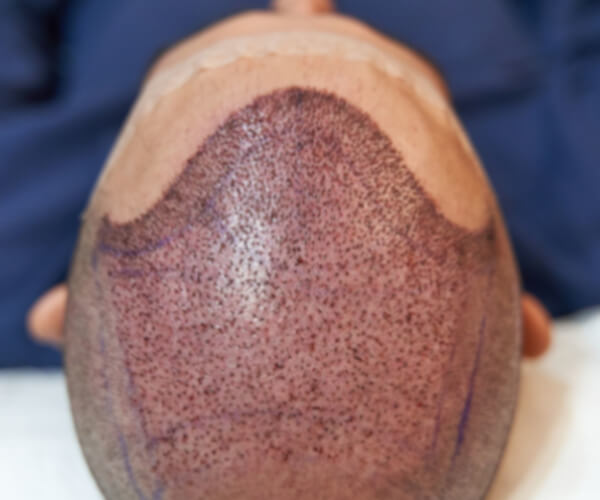 Trasplante de Cabello